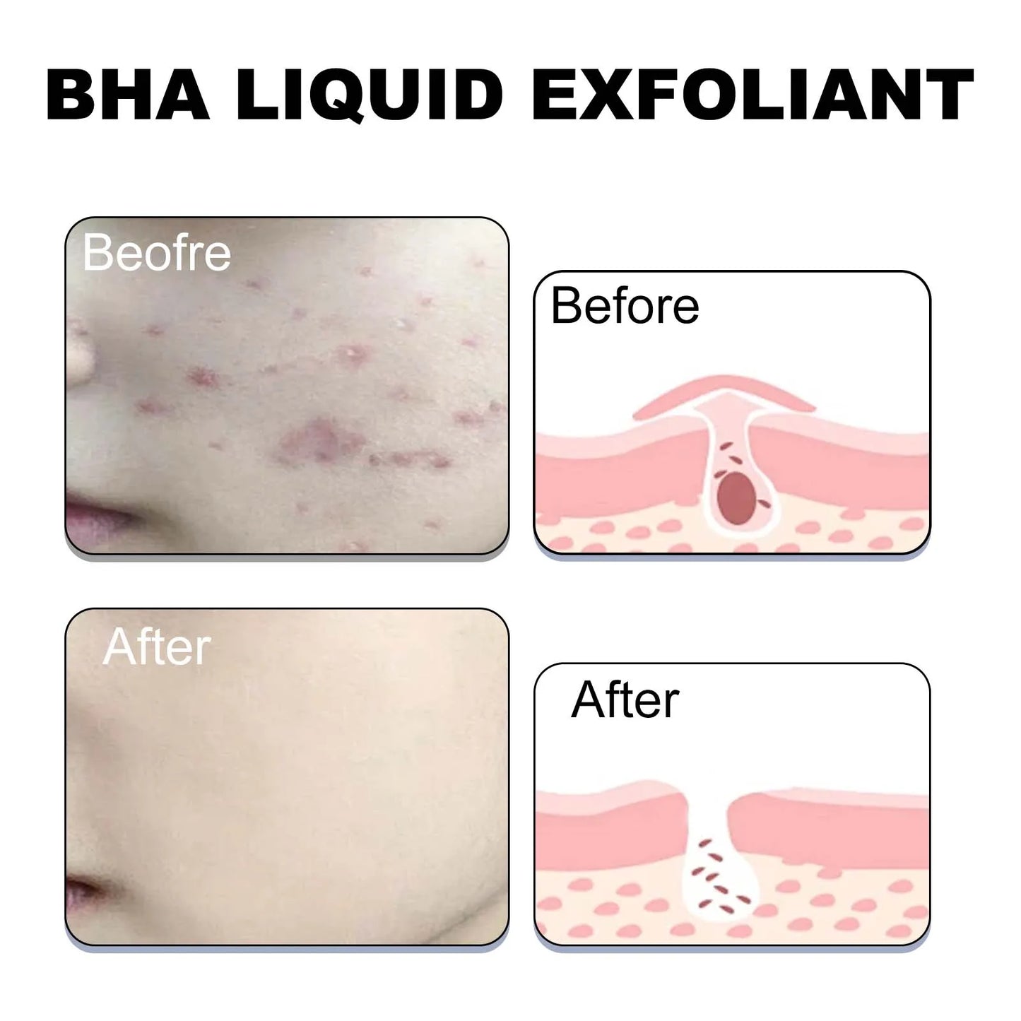 Salicylic Acid Serum 2% - Pore Minimizer & Exfoliant